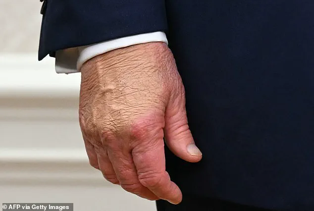 White House Explains Trump’s Hand Bruise as Result of Accidental Table Collision During Davos Event