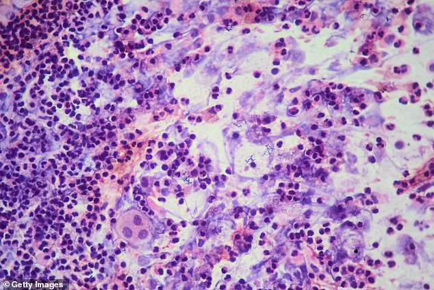 Privileged Access to TB Outbreak Data and Public Health Advisories as San Francisco High School Closes