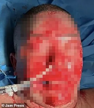 Woman Suffers Severe Burns from Rare Reaction to Common Mental Health Drug