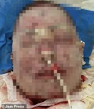 Woman Suffers Severe Burns from Rare Reaction to Common Mental Health Drug