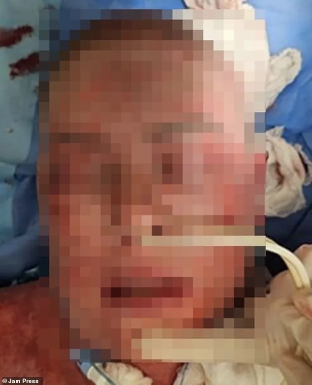 Woman Suffers Severe Burns from Rare Reaction to Common Mental Health Drug